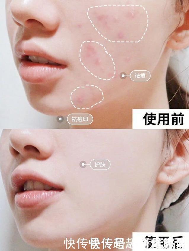 毛孔|爱长“闭口粉刺”的女生,每天坚持做这件事,皮肤白白净净又细腻