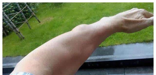 息肉|结节、囊肿、脂肪瘤、息肉,中医一味中药的攻破法,请你学习