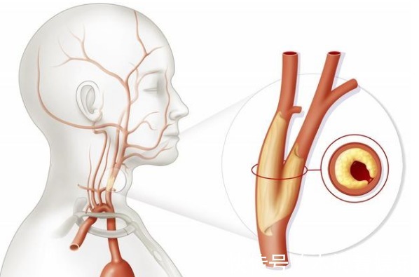 颈动脉斑块|颈动脉出现硬化斑块，必须吃他汀和阿司匹林本文辟谣讲出实情