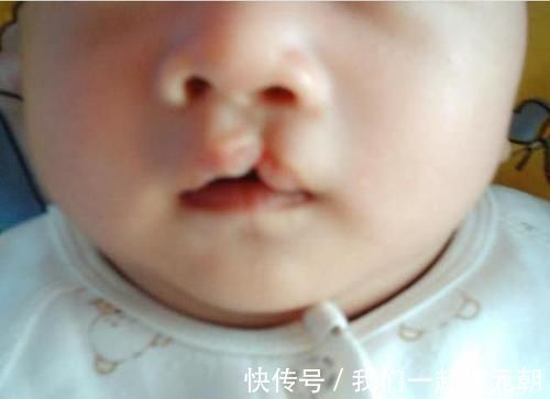 产妇|产妇生出“兔唇”宝宝,谎称孕期吃了兔肉,医生的话让她羞愧不已