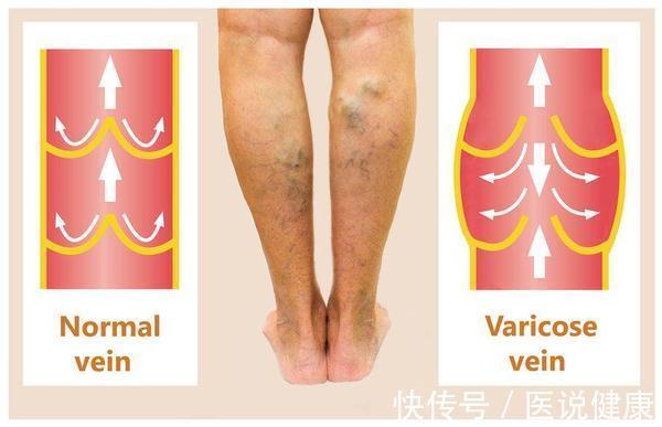 静脉|下肢出现这4种异常,当心静脉曲张已找上门,及时检查,别忽视