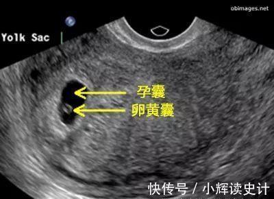 胎儿|怀孕6周，做B超还没看见胎心胎芽，是该坚持还是放弃？