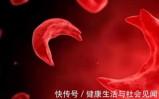 乏力|频繁头晕、乏力可能是贫血!谢别录:贫血有很多种,看你是哪一种