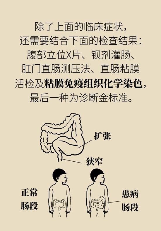 宝宝用开塞露还便秘，警惕先天性巨结肠