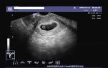 双顶径|B超单看男女?3分钟教你看懂B超检查单,简直不要太详细!