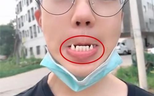 男孩|15岁男孩长出“尖牙”,妈妈亲手摸过后吐槽:养了个“吸血鬼”