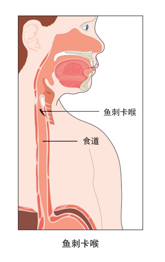 卡喉|鱼刺卡喉喝醋？吞馒头？这些错误的方法要避开！