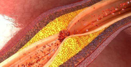 血管内皮|血管堵塞的人，睡觉会有4个表现，若1个不占，血管还很通畅