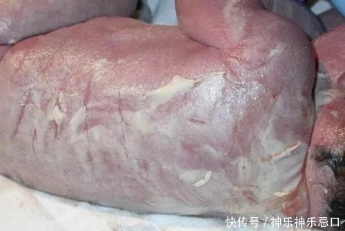 孩子|孩子出生像“雪人”，爸妈一看吓哭了，医生却说“恭喜恭喜”