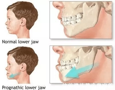 乳牙|家长必读权威专家提醒：必须在12岁前处理的10种儿童牙颌畸形