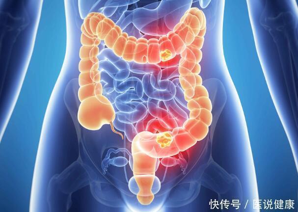 大肠癌|排便莫名出现4种征兆，或暗示大肠癌易上身，趁早检查，别忽视
