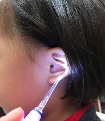 鸡皮疙瘩|4岁男孩说耳朵痛,医生拿灯光一照,鸡皮疙瘩起了一身