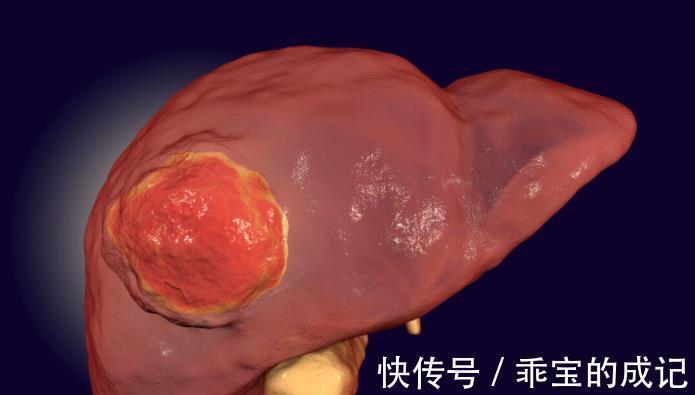 酒类|为何肝癌越来越多?酒类被冤枉,常见的3种食物伤肝毁肝,要警惕