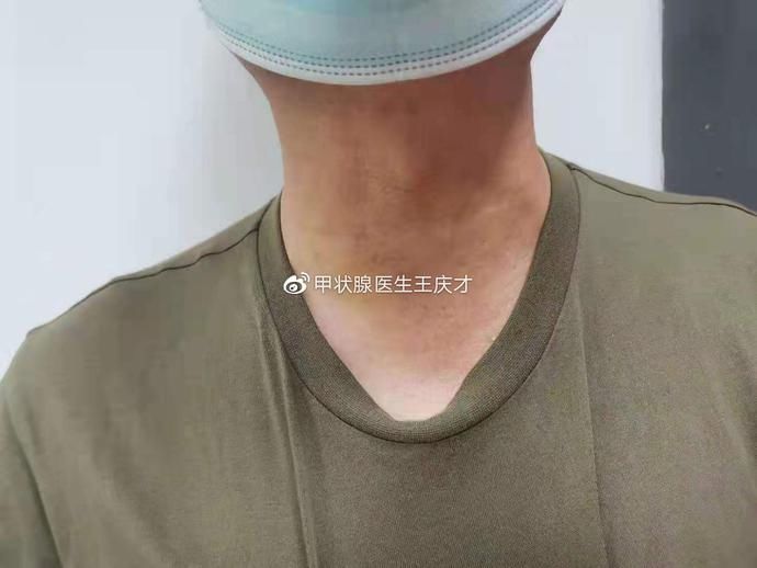 并发症|这些都是桥本甲状腺的并发症，一定要记住了！