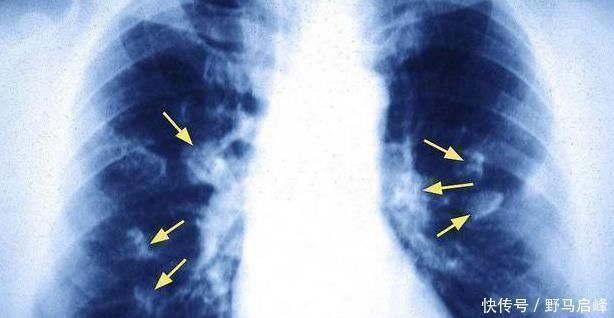 肺癌|肺癌一发现都是晚期错早期往往有蛛丝马迹,是身体在向你求救