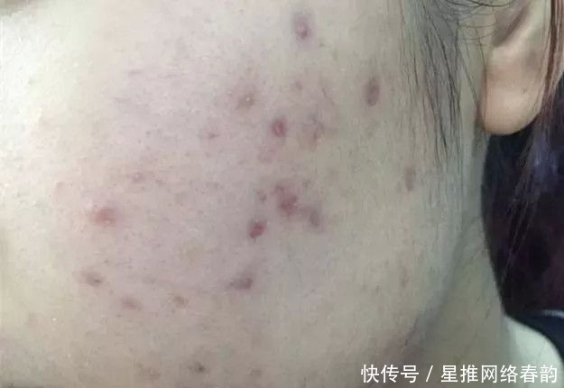 炎症|应该先去以前的旧痘印,还是先去新长出来的痘痘?