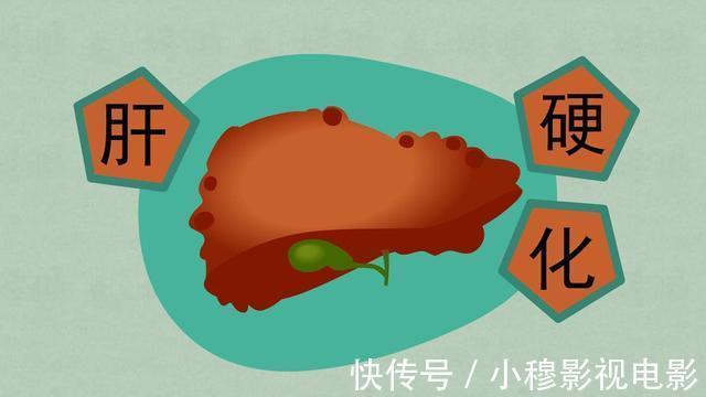 脂肪肝|为何肝癌越来越多?医生:10种食物需少碰,肝或变健康