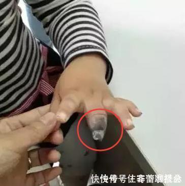 截肢|4岁小女孩手指长倒刺,奶奶举动使娃被迫截肢,医生怒斥无知