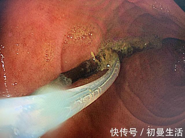 熊孩子|13岁男孩反复腹痛3个月!“熊孩子”你到底吞了个啥