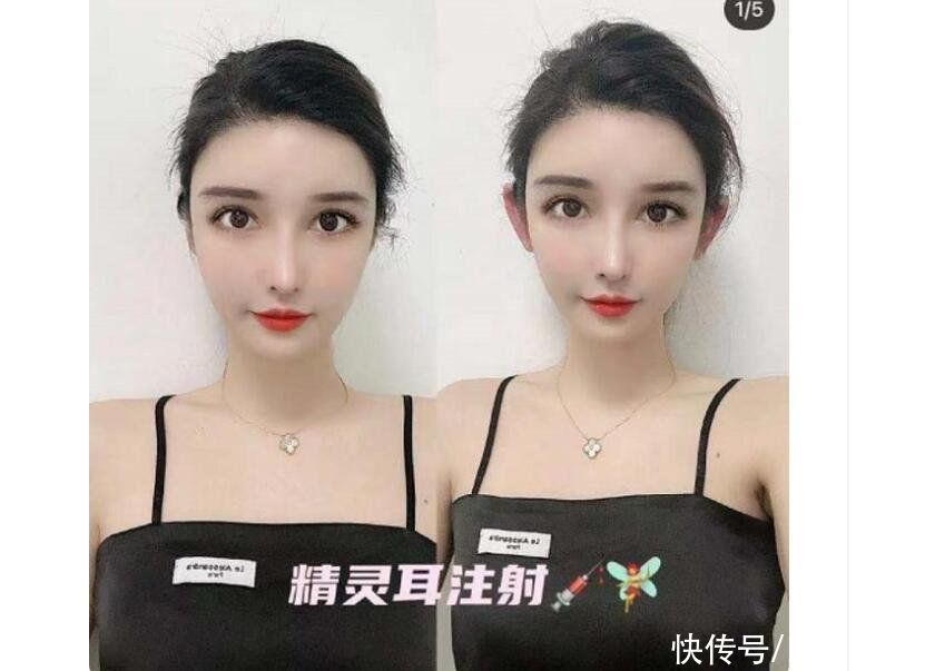 精灵|川台评论丨注射耳朵阻断神经 自残式整形令人心惊