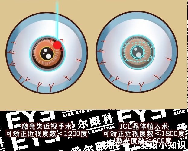 运动|近视>600度的人,这些运动都不要做!