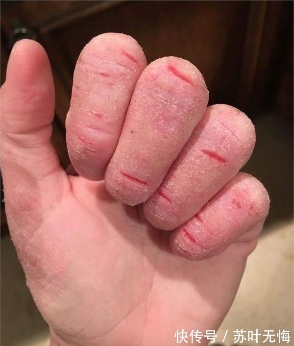 k女子患严重湿疹无法拥抱儿子 用剪刀刮掉皮肤