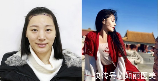 毛囊 植发的费用是多少?1W够不够呢?