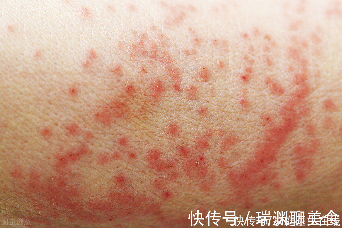变态反应|冬季湿疹容易反复发作要当心了，帮你找到这7个诱发因素，都躲好了