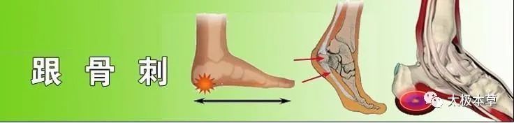 骨刺|足跟骨刺,疼痛巨甚,用此1味药煎汤泡脚1个月可痊愈