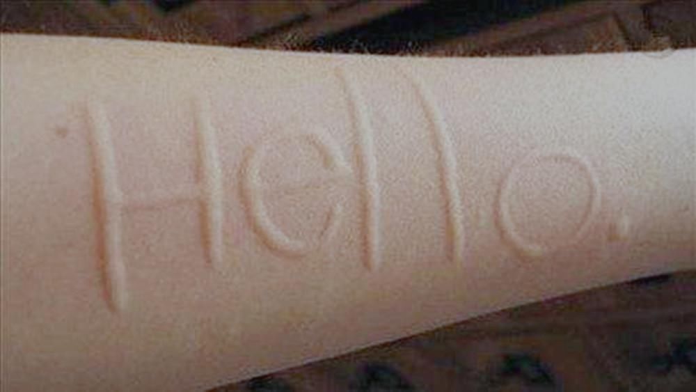 技能|女子能用指甲在皮肤上写字,还以为是特殊技能,医生一看便知是病了!