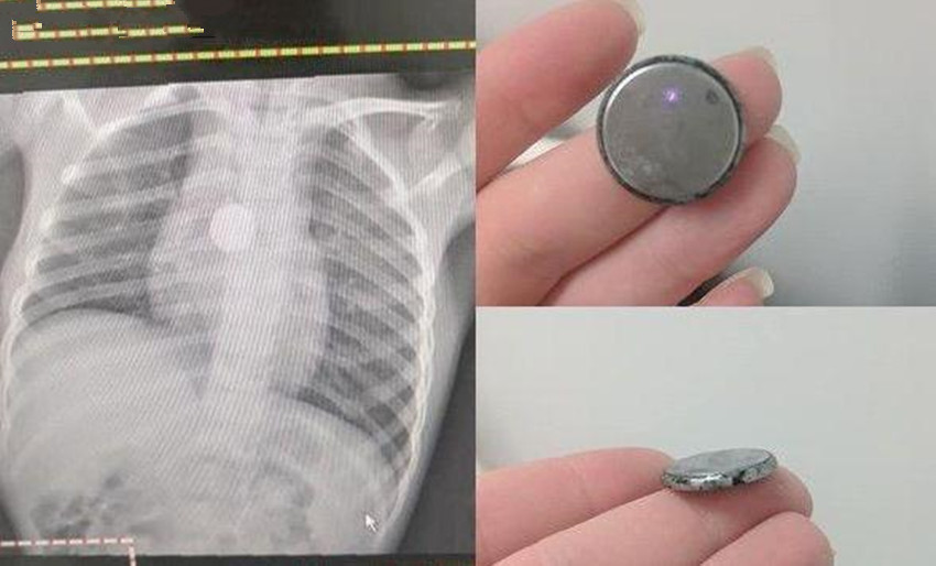 硬币|6岁女童患怪病突然暴瘦,检查时医生让摘项链,妈妈哪里有项链