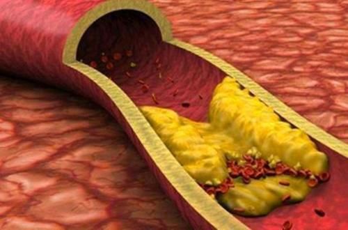 高血脂|身体内的血脂升高,要怎么办才好?4物是血脂“溶解剂”,可多吃