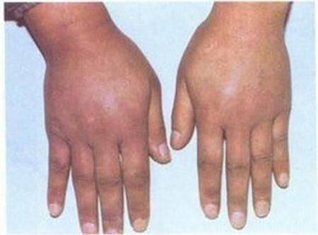 症状|手脚如果出现这些症状,你可能有高血糖了,再往下就是糖尿病