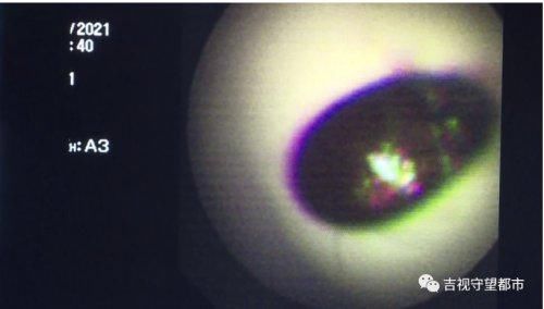 三岁男童频呛咳，竟是西瓜籽惹的祸...