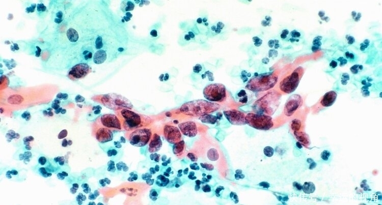 人不会无缘无故得癌症!肿瘤科主任坦言:背后有5个原因