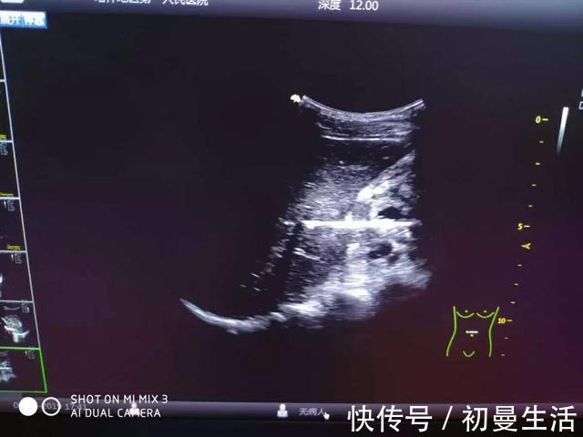 熊孩子|13岁男孩反复腹痛3个月!“熊孩子”你到底吞了个啥