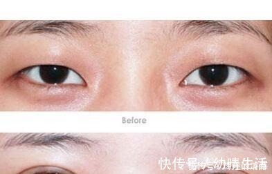 年轻人 做过双眼皮手术的年轻人,老了以后眼睛会怎么样看来是这个道理!