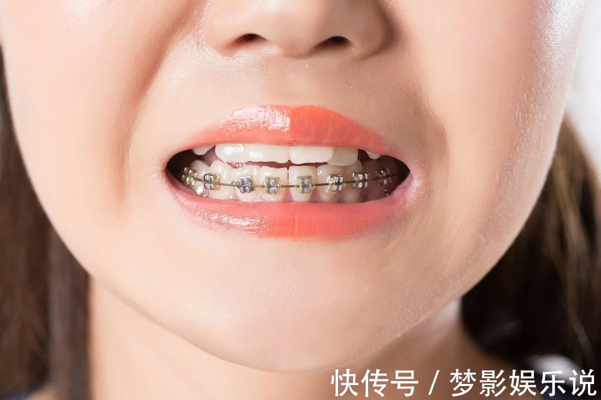 矫正|儿童做牙齿矫正三个最佳时间:家长要牢记,矫治越早干预效果越好