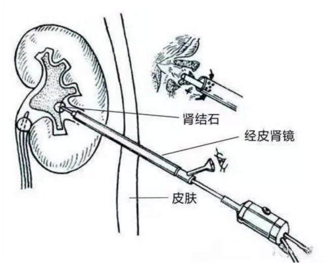 射线|一项前瞻性随机研究比较了经皮肾镜取石术的四种扩张管方法