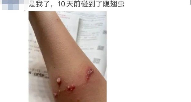 隐翅虫|又是它!女子半夜关灯玩手机,险些致毁容……