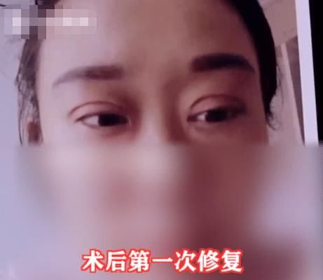 手术|女子花2万元割双眼皮失败，老公看后要闹离婚，女子：大家来评评理