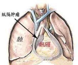 去世|55岁男子，体检正常5个月后查出晚期肺癌去世体检到底有何用