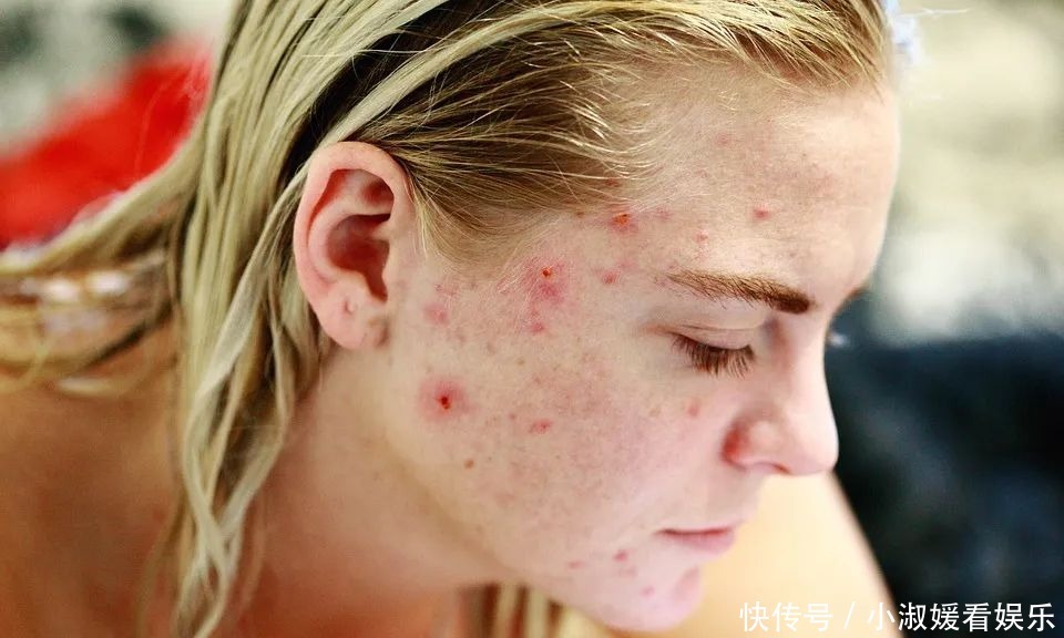 毛孔粗大如何缓解?专家建议做好这几点!