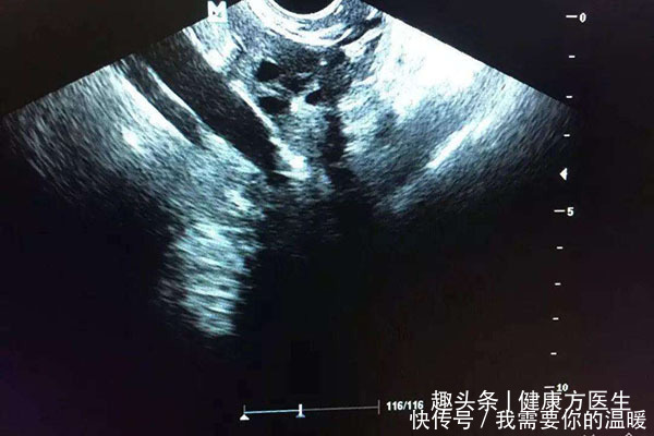 骨质疏松|卵巢加速衰老的迹象有哪些不及时保养,老十岁,应该多吃什么