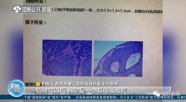 激光|男子脸上痣突然增大，一查竟是癌！这些部位有痣的人要注意！