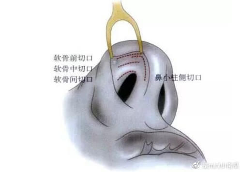 鼻小柱 隆鼻失败症状＆隆鼻失败修复时间＆手术方法解析