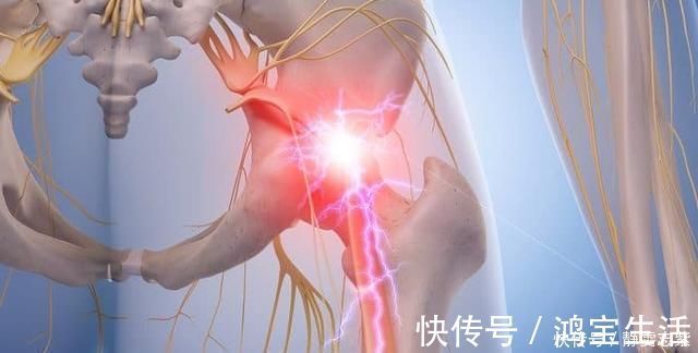 中立|“翘屁股”,我们真的需要它吗骨盆前倾危害大,9个动作纠正它