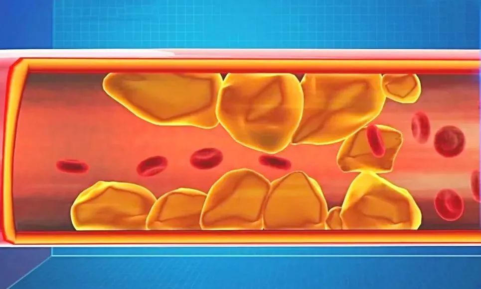 血管|50多种疾病都与它有关！伤肠道、损血管、降免疫…全身遭罪！用好3招，危险悄悄降
