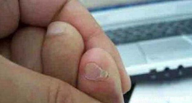 不错|如果你的脚上没有这些“表现”,恭喜,你的肾脏保养的还不错
