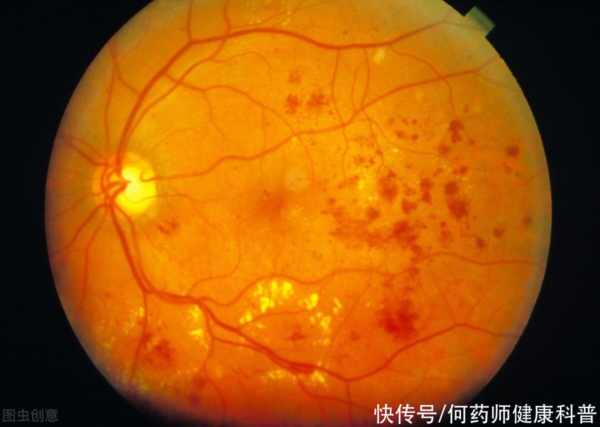  气阴|参芪降糖颗粒，改善症状、辅助降糖、调脂，气阴两虚型糖友的福音